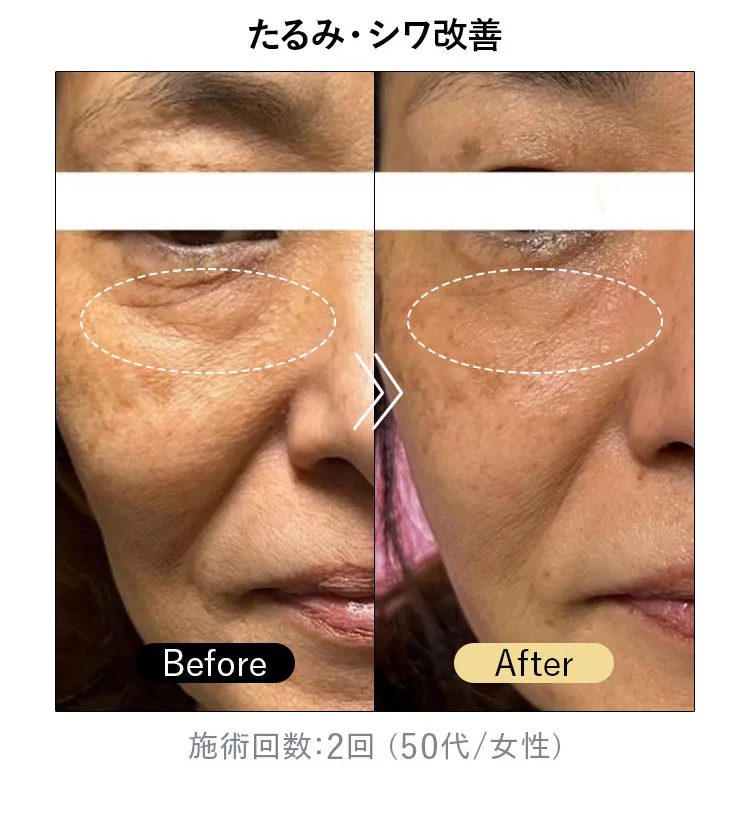 たるみ・シワ改善（施術回数2回・50代女性）