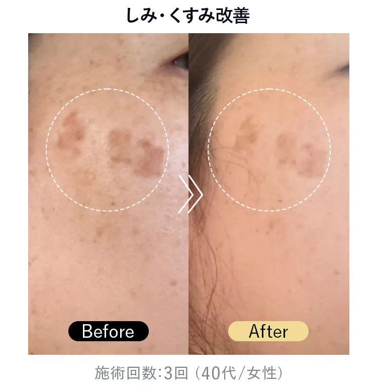 しみ・くすみ改善（施術回数3回・40代女性）