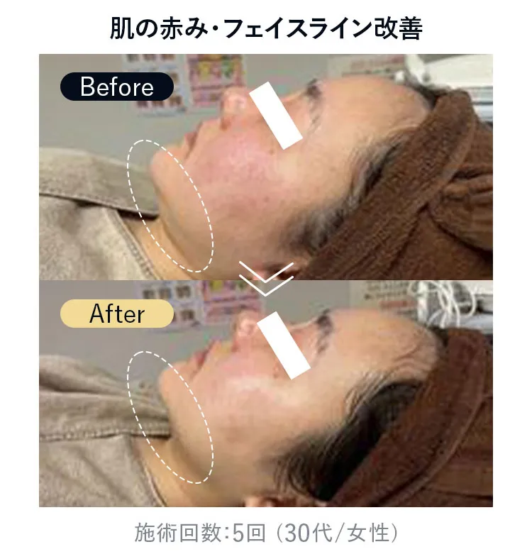 肌の赤み・フェイスライン改善（施術回数5回・30代女性）