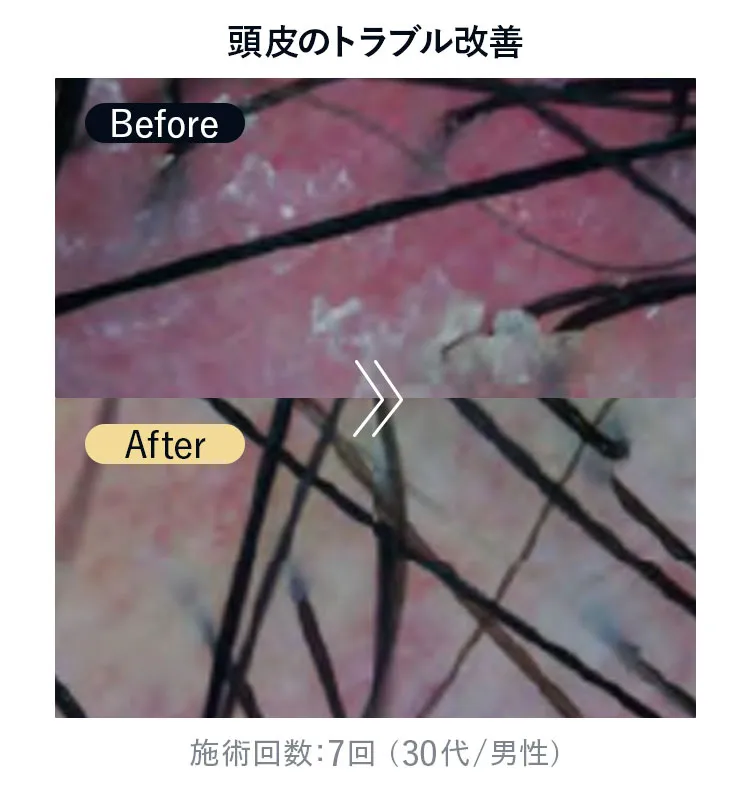 頭皮のトラブル改善（施術回数7回・30代男性）