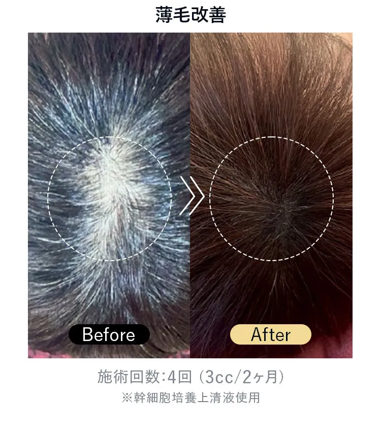薄毛改善（施術回数4回・3cc/2ヶ月）